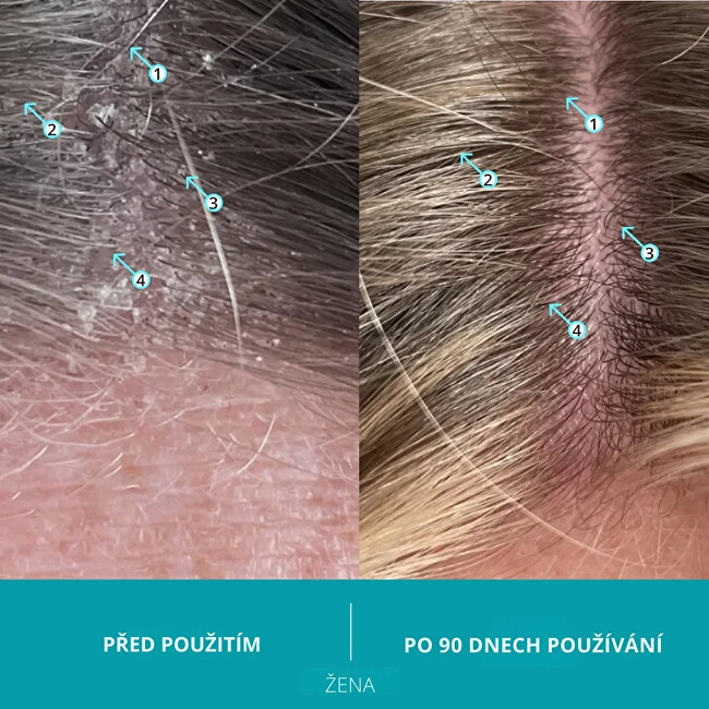 Ds Laboratories Dandrene (Anti-Dandruff Shampoo) 205 ml 205ml &scaron;ampūnas