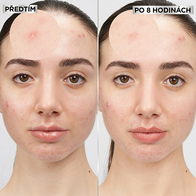 Garnier Hydrocolloid invisible patches with BHA for skin imperfections Pure Active (Pimple Patch) 8 pcs vietinės priežiūros priemonė