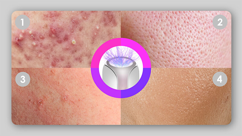 BeautyRelax PlasmaForce cosmetic device for mature skin vietinės priežiūros priemonė