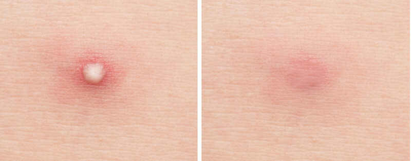 Mizon Good Bye Blemish Cleansing Patches (Clear Patch) 44 pcs vietinės priežiūros priemonė